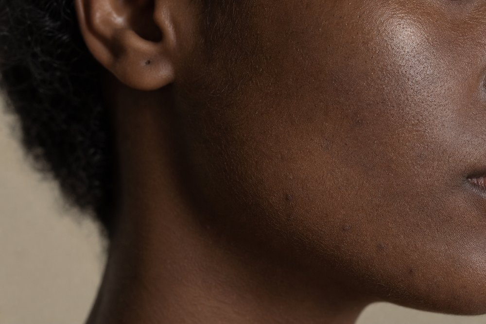 Hyperpigmentation 101: What Actually Works for Melanin-Rich Skin