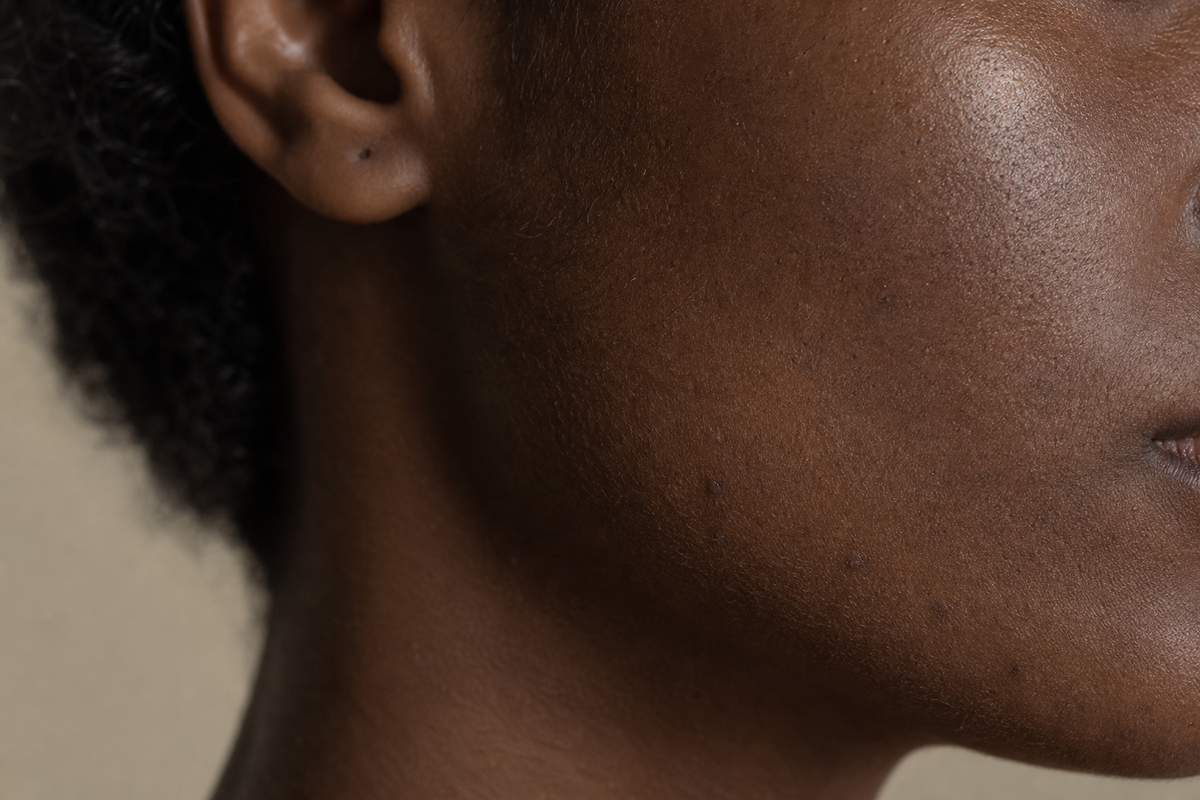 Hyperpigmentation 101: What Actually Works for Melanin-Rich Skin
